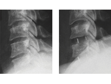 cerv-x_indicaciones